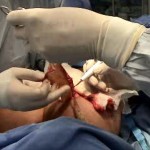 Surgery