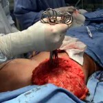 Surgery